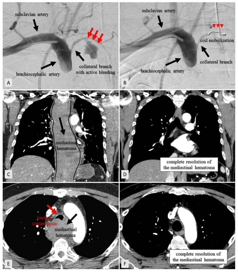 Coil Embolization for Complications Following PCI JIC